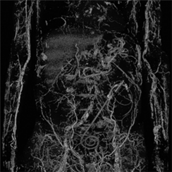 Widespread Calcifications Delineating an Arterial Vessel Tree in a Peritoneal Dialysis Patient
